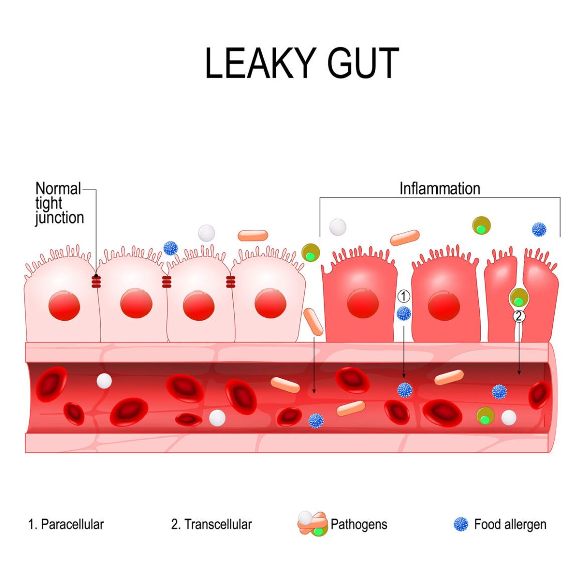 Illustration Leaky Gut Syndrom, durchlässiger Darm