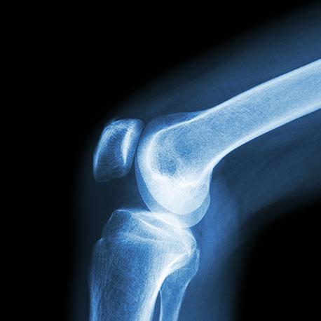 Röntgenbild eines Knies –  Calcium, Vitamin D3 und Vitamin K unterstützen Deine Knochen und Zähne